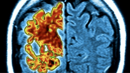 新检测技术可望推进阿尔茨海默病早期诊断